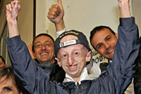 Operato al cuore paziente con progeria