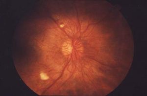 Retinopatia, patologia per un milione