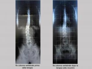 Mal di schiena e dolori articolari ? Con la Fisioanalisi si guarisce definitivamente