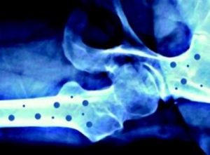 Osteoporosi, screening gratis in 18 ospedali per le donne