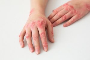 Salutequità e Apiafco “La psoriasi entri nel Piano Nazionale Cronicità”